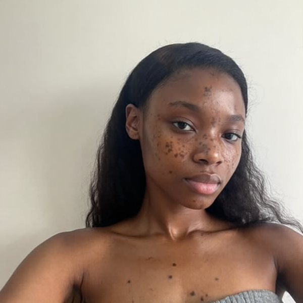 Evens skin tone